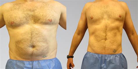 Cryolipolysis reduces fat in the treatment area by 20. . Sono bello before and after stomach